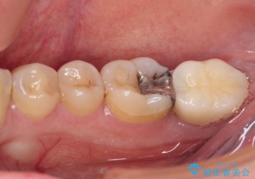 奥歯のむし歯が痛む セラミッククラウンとゴールドインレーによるむし歯治療の治療後