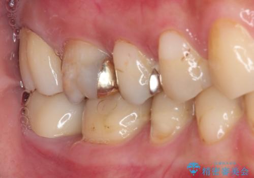 奥歯のむし歯が痛む　セラミッククラウンとゴールドインレーによるむし歯治療の症例 治療後