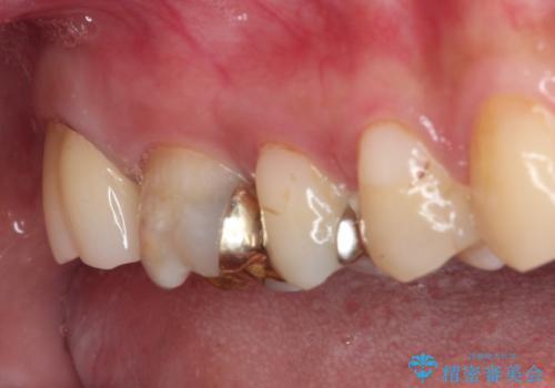 奥歯のむし歯が痛む セラミッククラウンとゴールドインレーによるむし歯治療の治療後