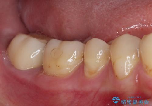 奥歯のむし歯が痛む　セラミッククラウンとゴールドインレーによるむし歯治療
