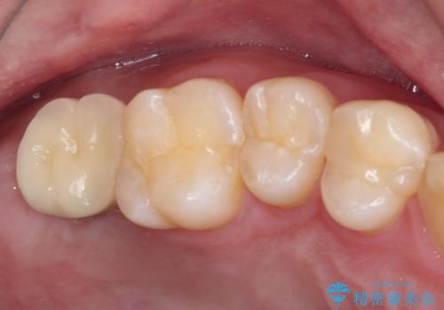 歯に穴を開けられてしまった インプラントによる奥歯の補綴治療の症例 治療後