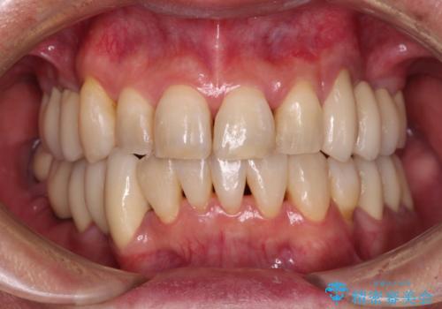 歯並びや奥歯の痛み　色々と治したい　総合歯科診療の症例 治療後