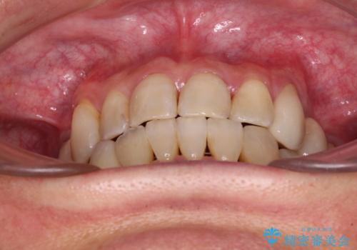 歯並びや奥歯の痛み　色々と治したい　総合歯科診療の治療後