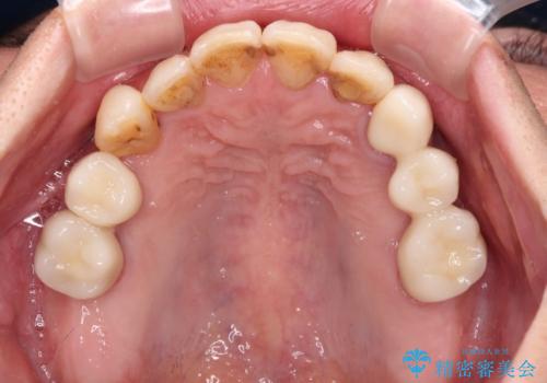 歯並びや奥歯の痛み　色々と治したい　総合歯科診療の治療後