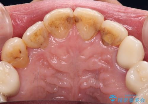 歯並びや奥歯の痛み 色々と治したい 総合歯科診療の治療後