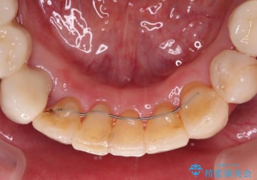 歯並びや奥歯の痛み 色々と治したい 総合歯科診療の治療後