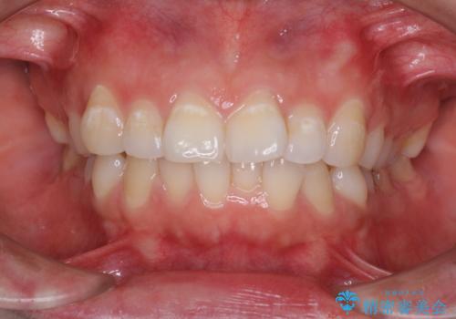 ふっくらとした口元を改善したい　目立たないワイヤー装置による抜歯矯正の症例 治療前