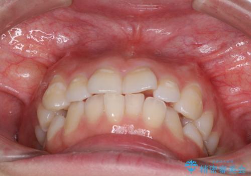 ふっくらとした口元を改善したい　目立たないワイヤー装置による抜歯矯正の治療前