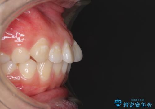 ふっくらとした口元を改善したい 目立たないワイヤー装置による抜歯矯正の治療前