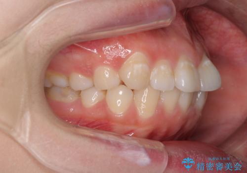 ふっくらとした口元を改善したい 目立たないワイヤー装置による抜歯矯正の治療前