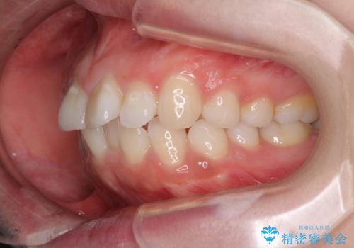 ふっくらとした口元を改善したい 目立たないワイヤー装置による抜歯矯正の治療前