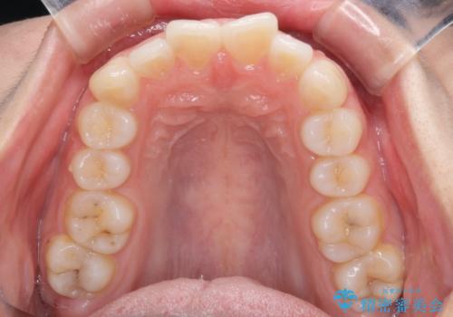 ふっくらとした口元を改善したい 目立たないワイヤー装置による抜歯矯正の治療前
