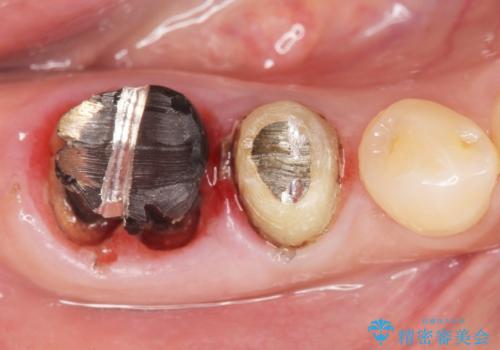 奥歯が割れている 抜歯してインプラントへ 40代女性の治療中
