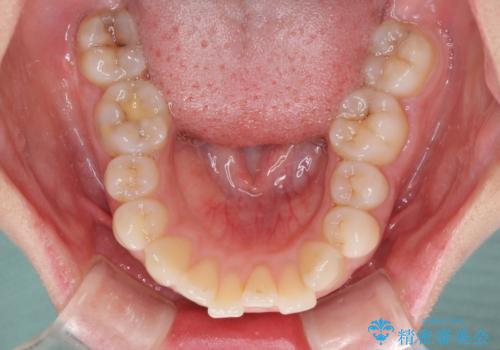 ふっくらとした口元を改善したい 目立たないワイヤー装置による抜歯矯正の治療前