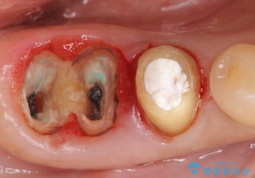 奥歯が割れている 抜歯してインプラントへ 40代女性の治療中
