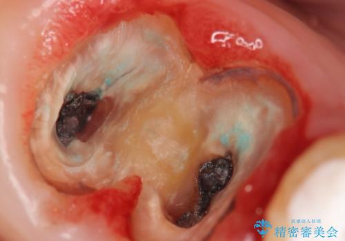 奥歯が割れている 抜歯してインプラントへ 40代女性の治療中