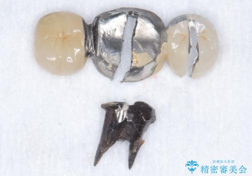 奥歯が割れている 抜歯してインプラントへ 40代女性の治療中