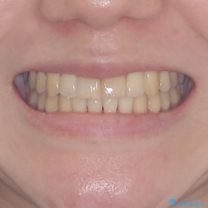 上下前歯のデコボコをきれいに　インビザラインによる矯正治療の治療後（顔貌）