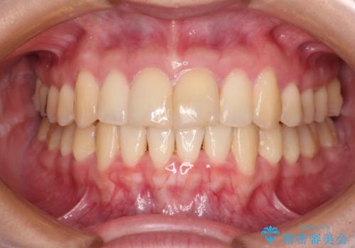 上下前歯のデコボコをきれいに インビザラインによる矯正治療の治療後