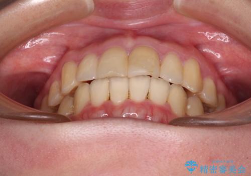 上下前歯のデコボコをきれいに インビザラインによる矯正治療の治療後
