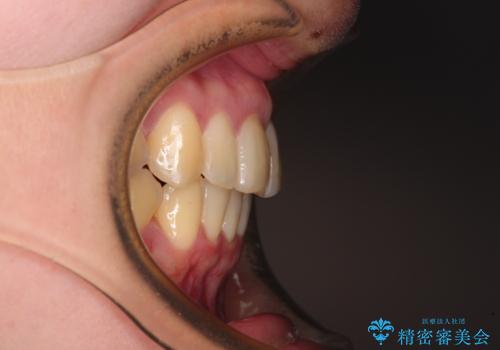 上下前歯のデコボコをきれいに　インビザラインによる矯正治療の治療後