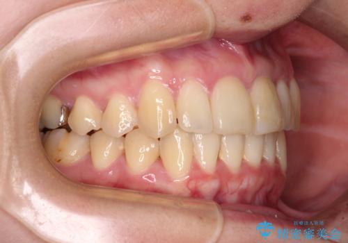 上下前歯のデコボコをきれいに インビザラインによる矯正治療の治療後