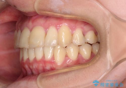 上下前歯のデコボコをきれいに　インビザラインによる矯正治療の治療後