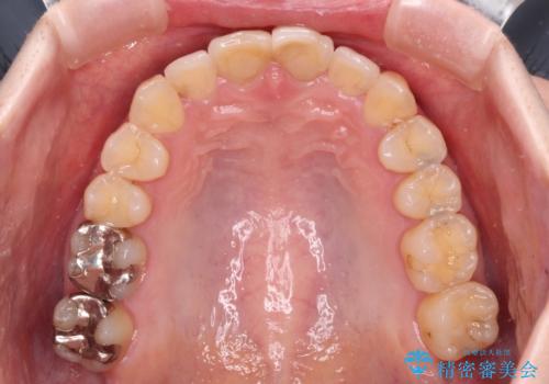 上下前歯のデコボコをきれいに インビザラインによる矯正治療の治療後