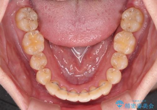 上下前歯のデコボコをきれいに インビザラインによる矯正治療の治療後