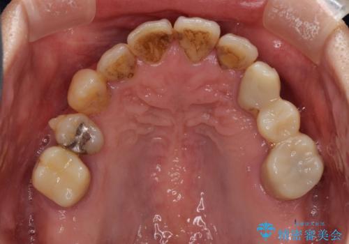 歯並びや奥歯の痛み　色々と治したい　総合歯科診療の治療中