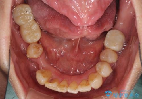 歯並びや奥歯の痛み　色々と治したい　総合歯科診療の治療中