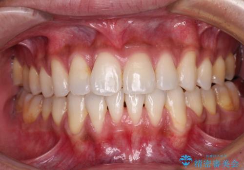 上顎の狭い歯列をインビザラインで拡大の症例 治療後