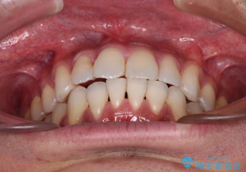 上顎の狭い歯列をインビザラインで拡大の治療後