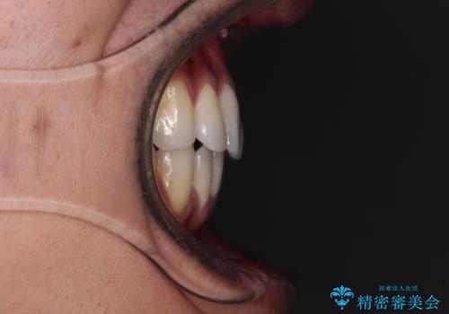 上顎の狭い歯列をインビザラインで拡大の治療後