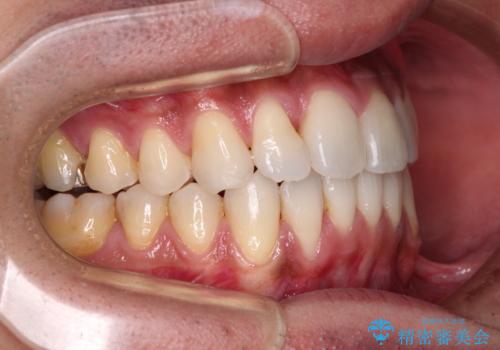 上顎の狭い歯列をインビザラインで拡大の治療後