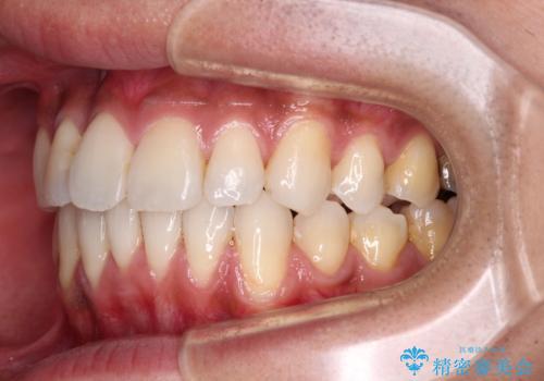 上顎の狭い歯列をインビザラインで拡大の治療後