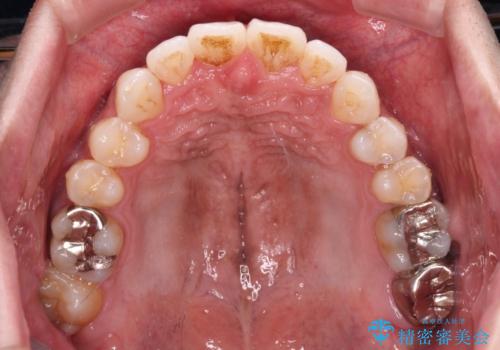 上顎の狭い歯列をインビザラインで拡大の治療後