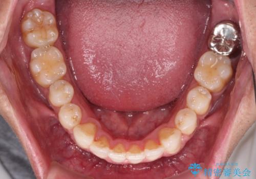 上顎の狭い歯列をインビザラインで拡大の治療後