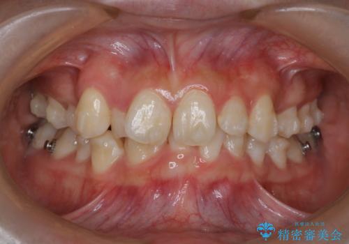 【インビザライン】抜歯矯正の治療中