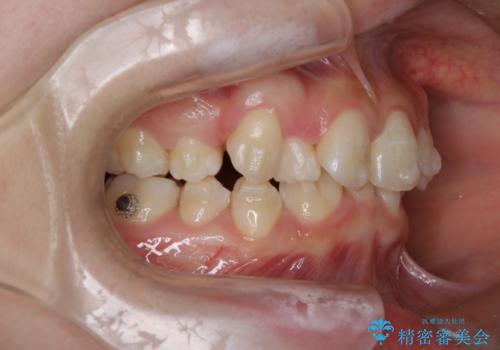 【インビザライン】抜歯矯正の治療中