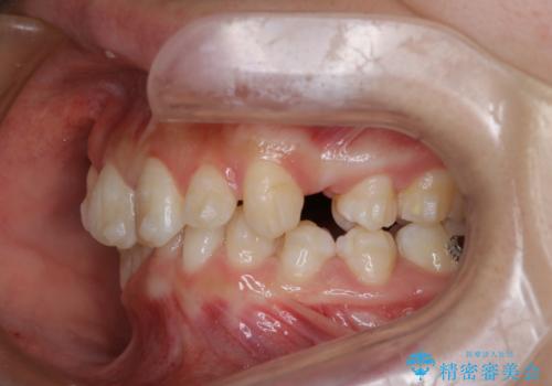 【インビザライン】抜歯矯正の治療中