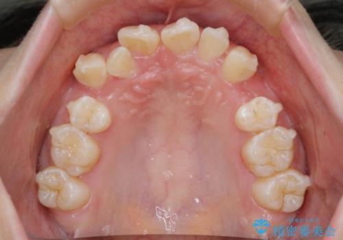 【インビザライン】抜歯矯正の治療中