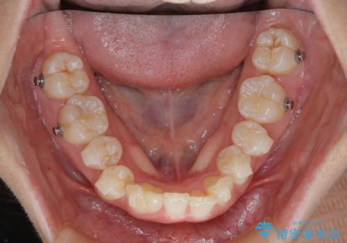 【インビザライン】抜歯矯正の治療中