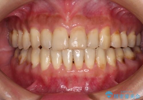 どこで咬んで良いのか分からない インビザラインでの咬み合わせの改善