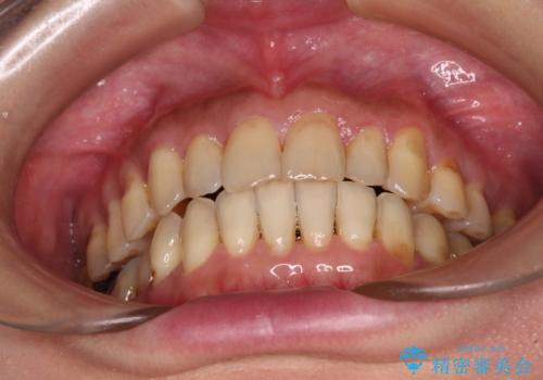 どこで咬んで良いのか分からない インビザラインでの咬み合わせの改善の治療後