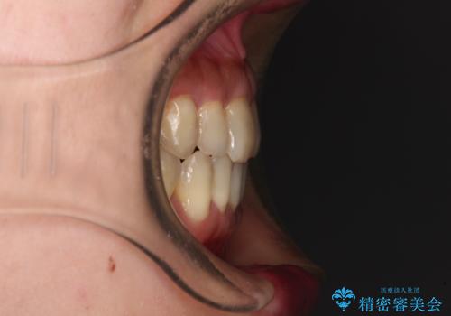 どこで咬んで良いのか分からない インビザラインでの咬み合わせの改善の治療後