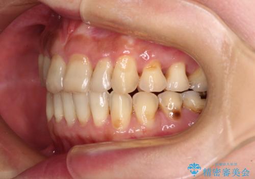 どこで咬んで良いのか分からない インビザラインでの咬み合わせの改善の治療後