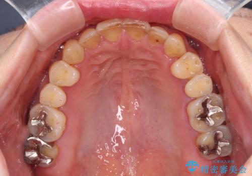 どこで咬んで良いのか分からない インビザラインでの咬み合わせの改善の治療後