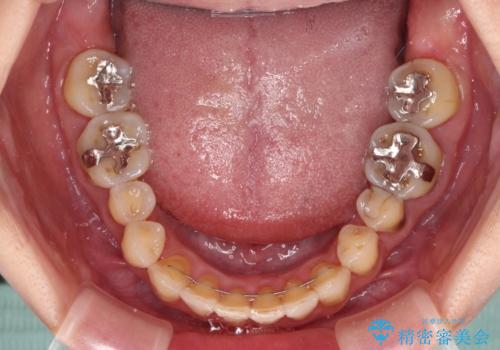 どこで咬んで良いのか分からない インビザラインでの咬み合わせの改善の治療後