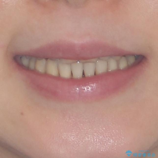 どこで咬んで良いのか分からない インビザラインでの咬み合わせの改善の治療後(顔貌)